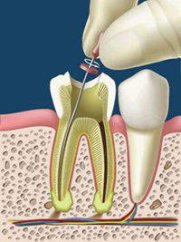 conservativa-endodonzia-1